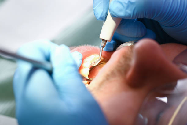 Best Emergency Tooth Extraction in Britton, SD