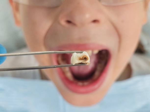 Best Emergency Tooth Extraction in Britton, SD